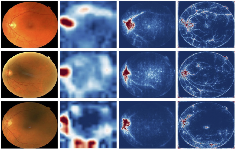 Deep Learning Helps Detect Anemia From Eye Images 7469